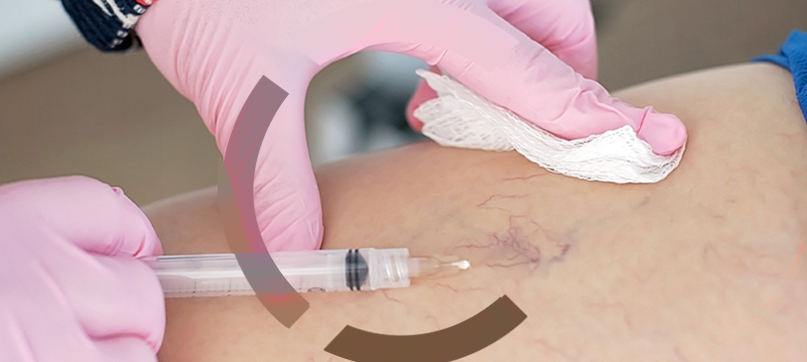 Imagem interna tratamento de vasinhos da face Clariana Casali