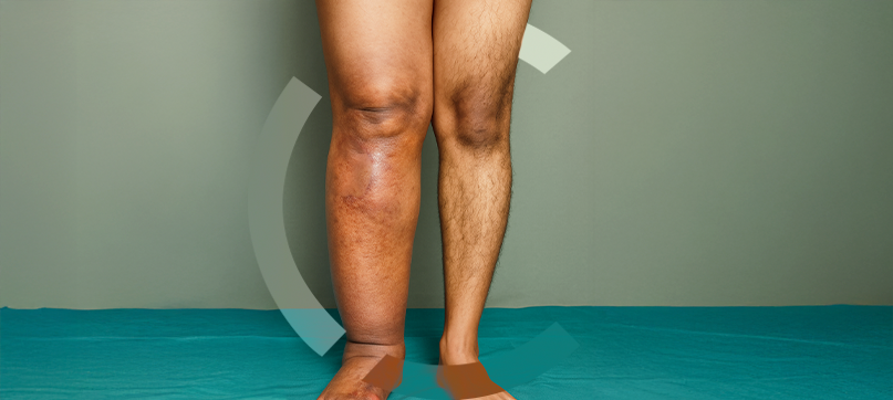 Imagem interna tratamento de vasinhos da face Clariana Casali