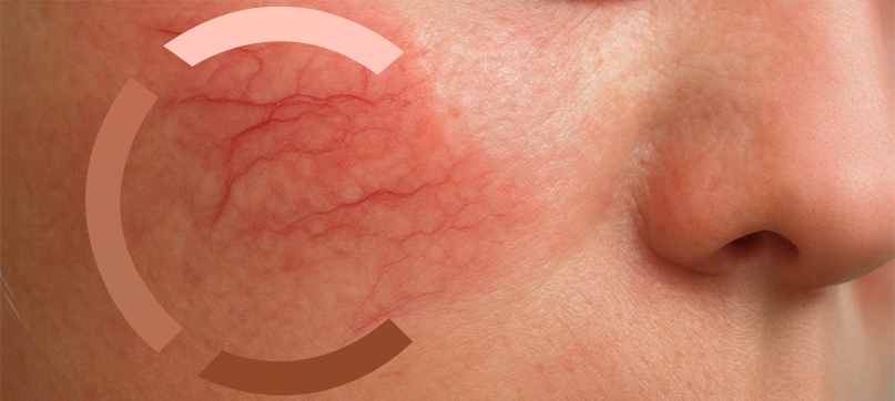 Imagem interna tratamento de vasinhos da face Clariana Casali